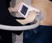 Coolsculpting Cost in Vancouver